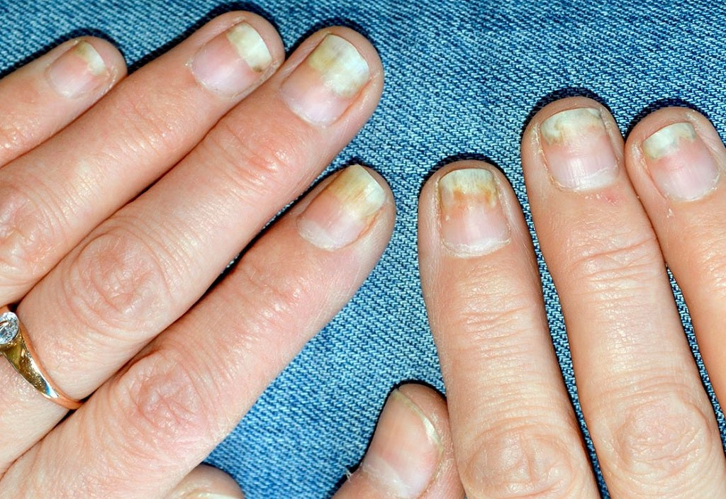 Nail Psoriasis or Fungus